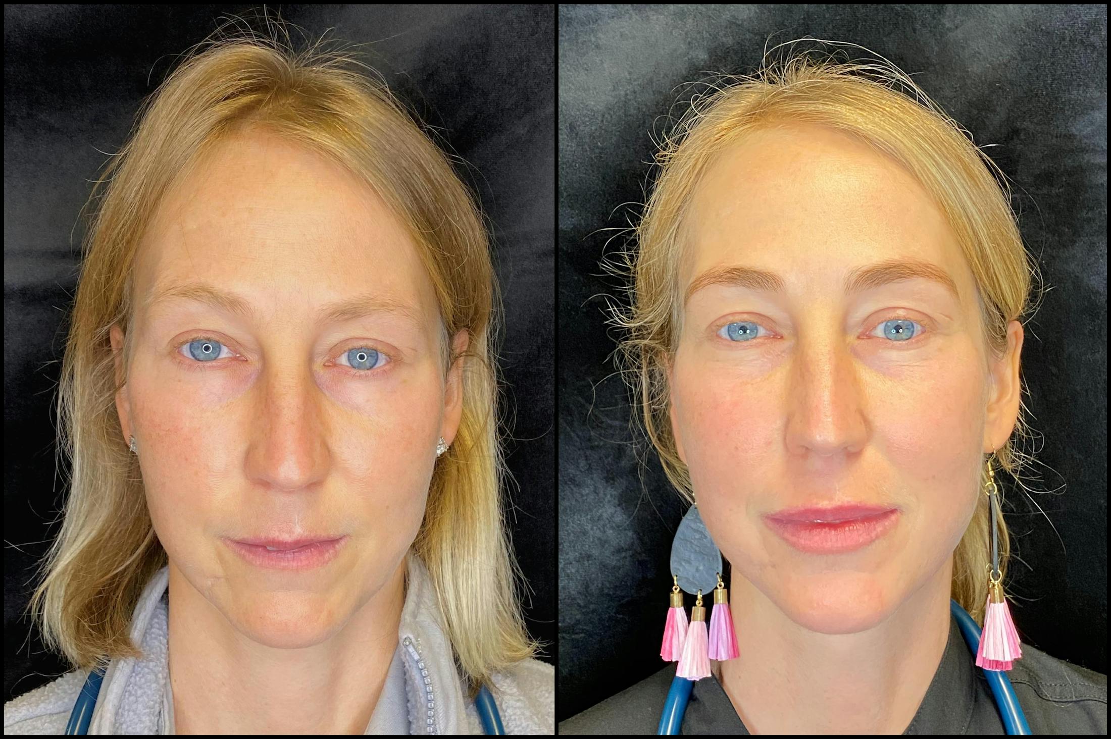 BOTOX/Dysport Before & After Gallery - Patient 83697325 - Image 1