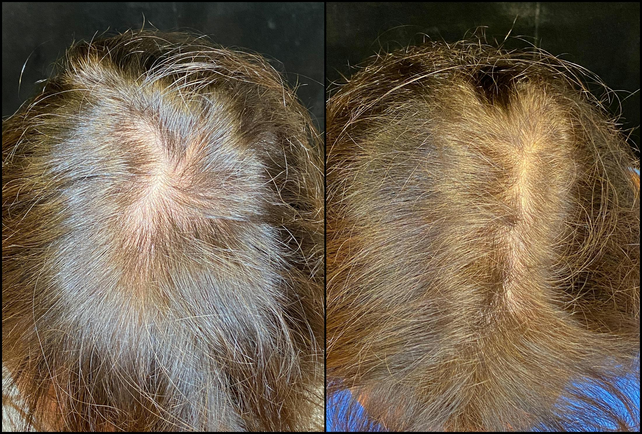 PRP Hair Restoration Before & After Gallery - Patient 154143469 - Image 1