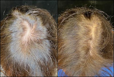 PRP Hair Restoration Before & After Gallery - Patient 154143469 - Image 1
