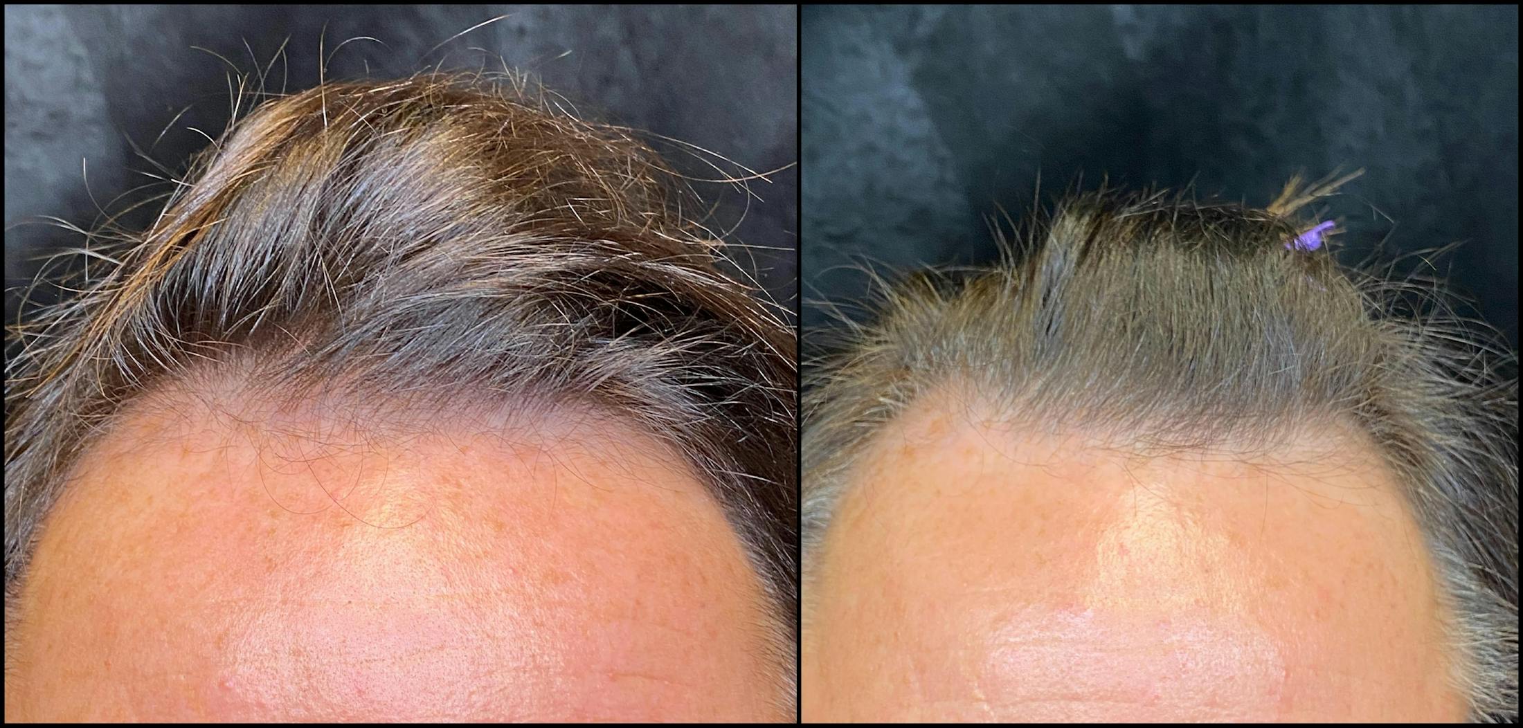 PRP Hair Restoration Before & After Gallery - Patient 154143469 - Image 2