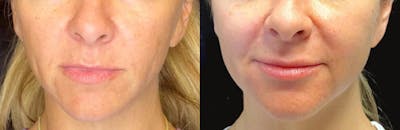 PRP Before & After Gallery - Patient 83698596 - Image 1