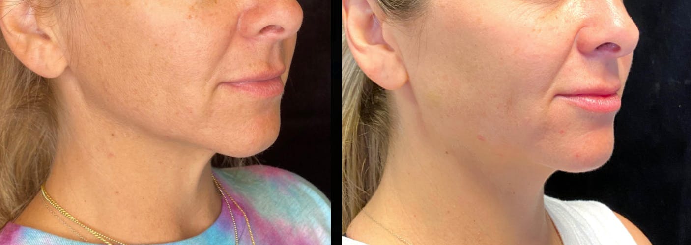 PRP Before & After Gallery - Patient 83698596 - Image 3