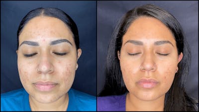 Chemical Peels Before & After Gallery - Patient 83697837 - Image 1