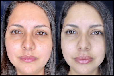 Dermal Fillers Before & After Gallery - Patient 83697692 - Image 1
