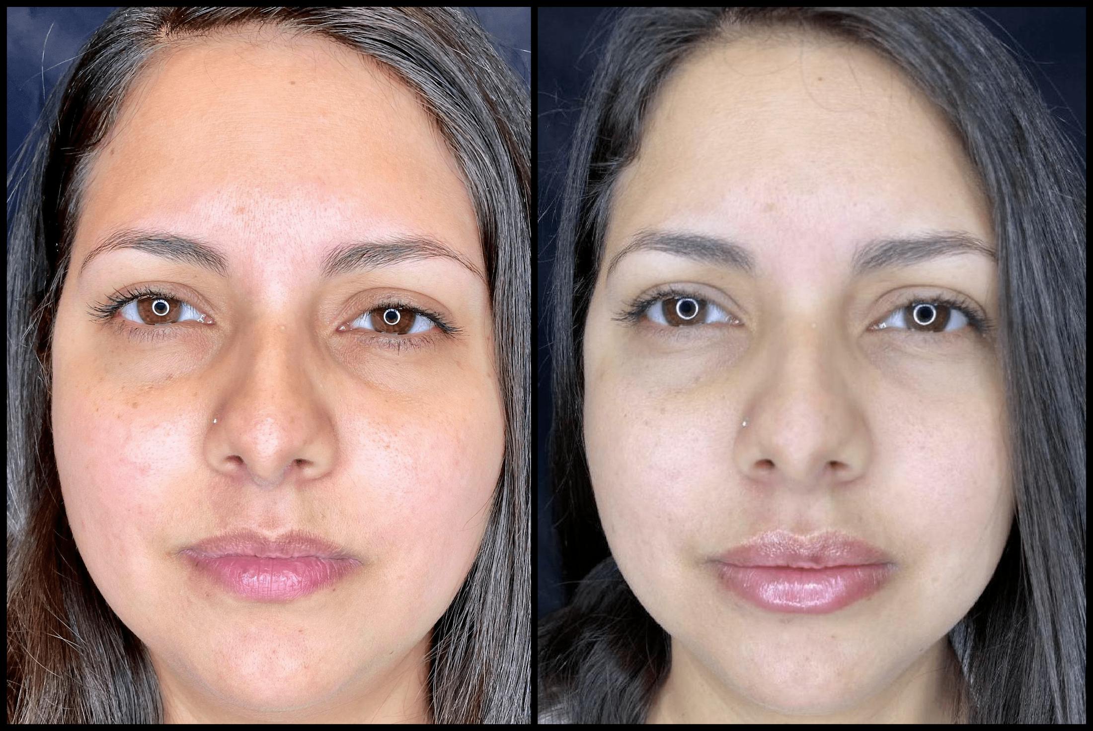 Dermal Fillers Before & After Gallery - Patient 83697692 - Image 1