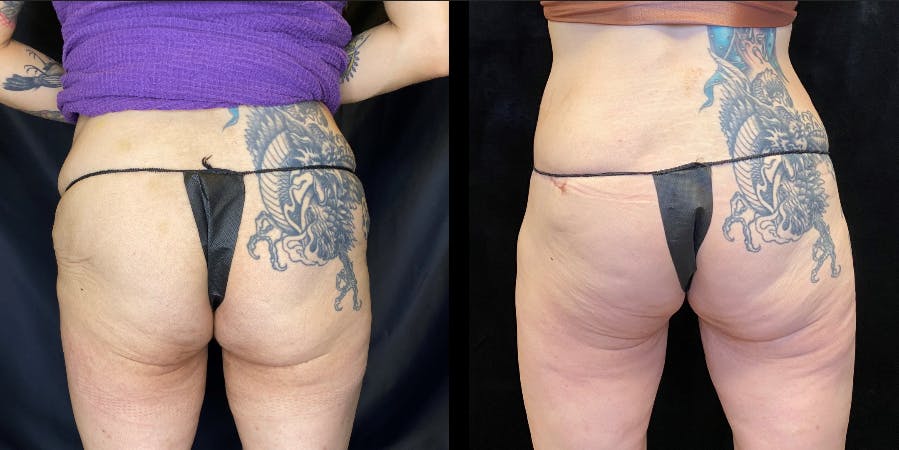EvolveX Before & After Gallery - Patient 154143633 - Image 1
