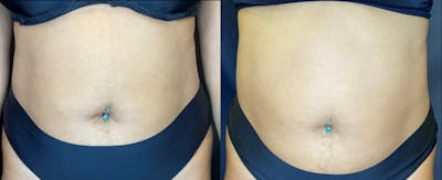 SculpSure Before & After Gallery - Patient 83698708 - Image 1