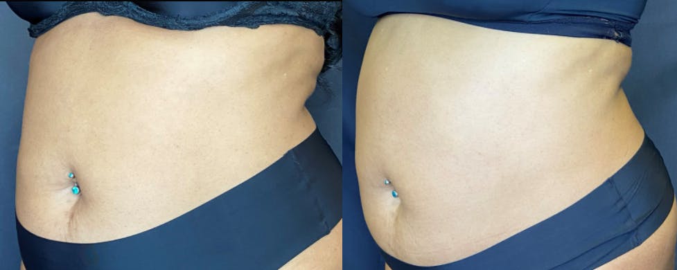 SculpSure Before & After Gallery - Patient 83698708 - Image 2