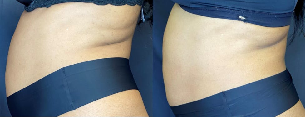 SculpSure Before & After Gallery - Patient 83698708 - Image 3