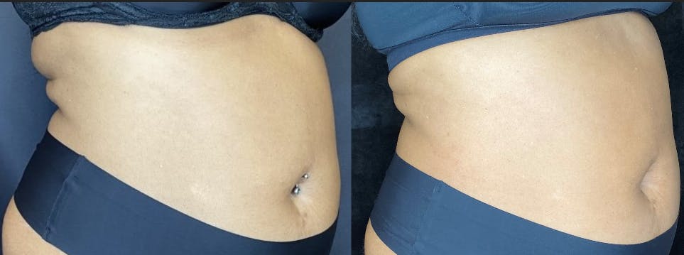 SculpSure Before & After Gallery - Patient 83698708 - Image 4