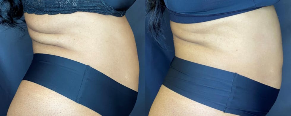 SculpSure Before & After Gallery - Patient 83698708 - Image 5