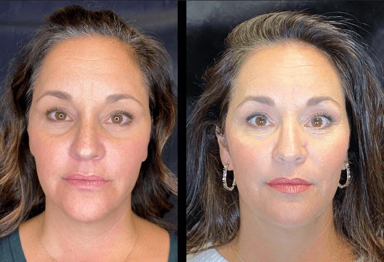 AccuTite & FaceTite Before & After Gallery - Patient 92120607 - Image 1