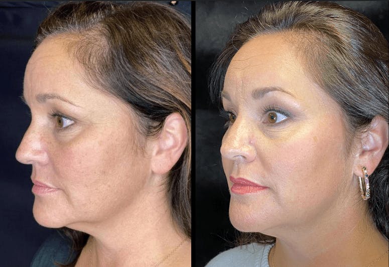 AccuTite & FaceTite Before & After Gallery - Patient 92120607 - Image 2