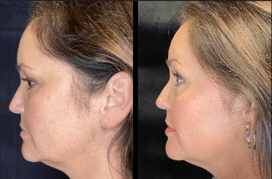 AccuTite & FaceTite Before & After Gallery - Patient 92120607 - Image 3