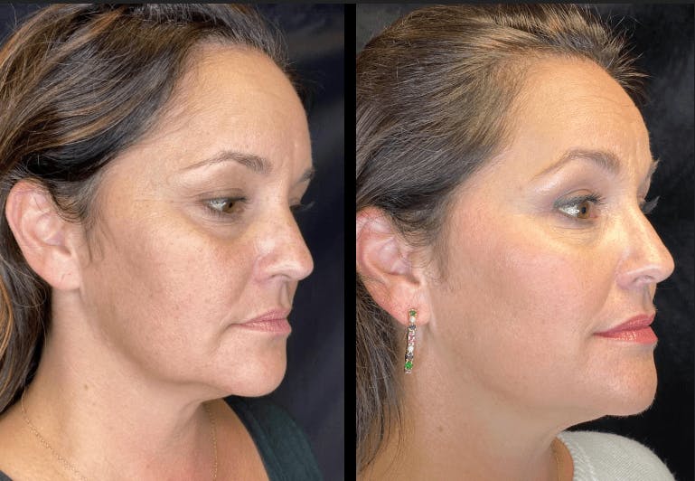 AccuTite & FaceTite Before & After Gallery - Patient 92120607 - Image 4