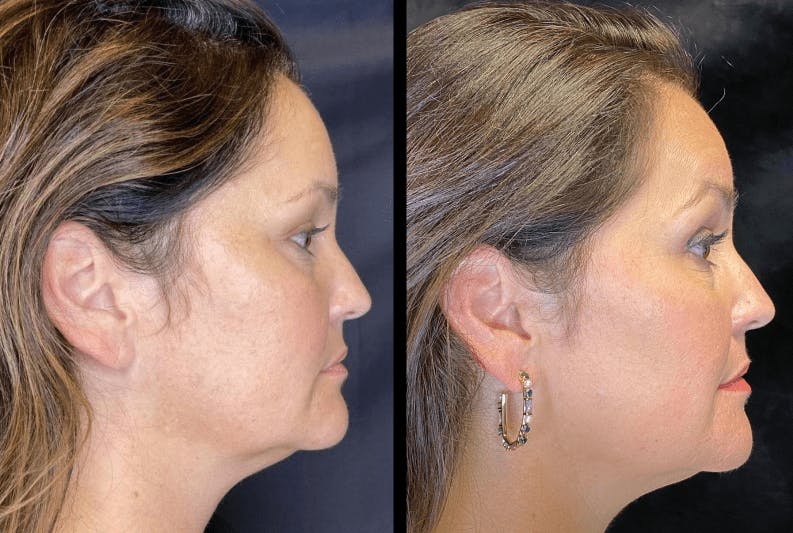 PRP Before & After Gallery - Patient 92120635 - Image 5