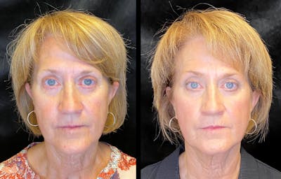 Morpheus8 Before & After Gallery - Patient 92120626 - Image 1