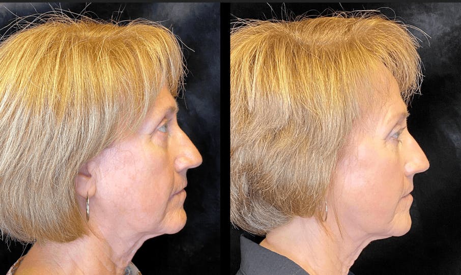 Morpheus8 Before & After Gallery - Patient 92120626 - Image 4