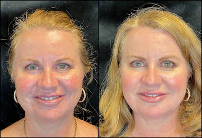 Dermal Fillers Before & After Gallery - Patient 92120664 - Image 1