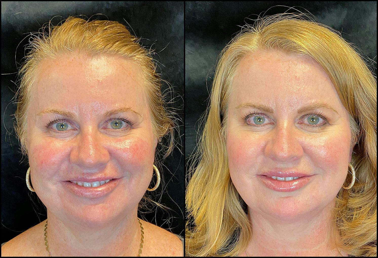 Dermal Fillers Before & After Gallery - Patient 92120664 - Image 1