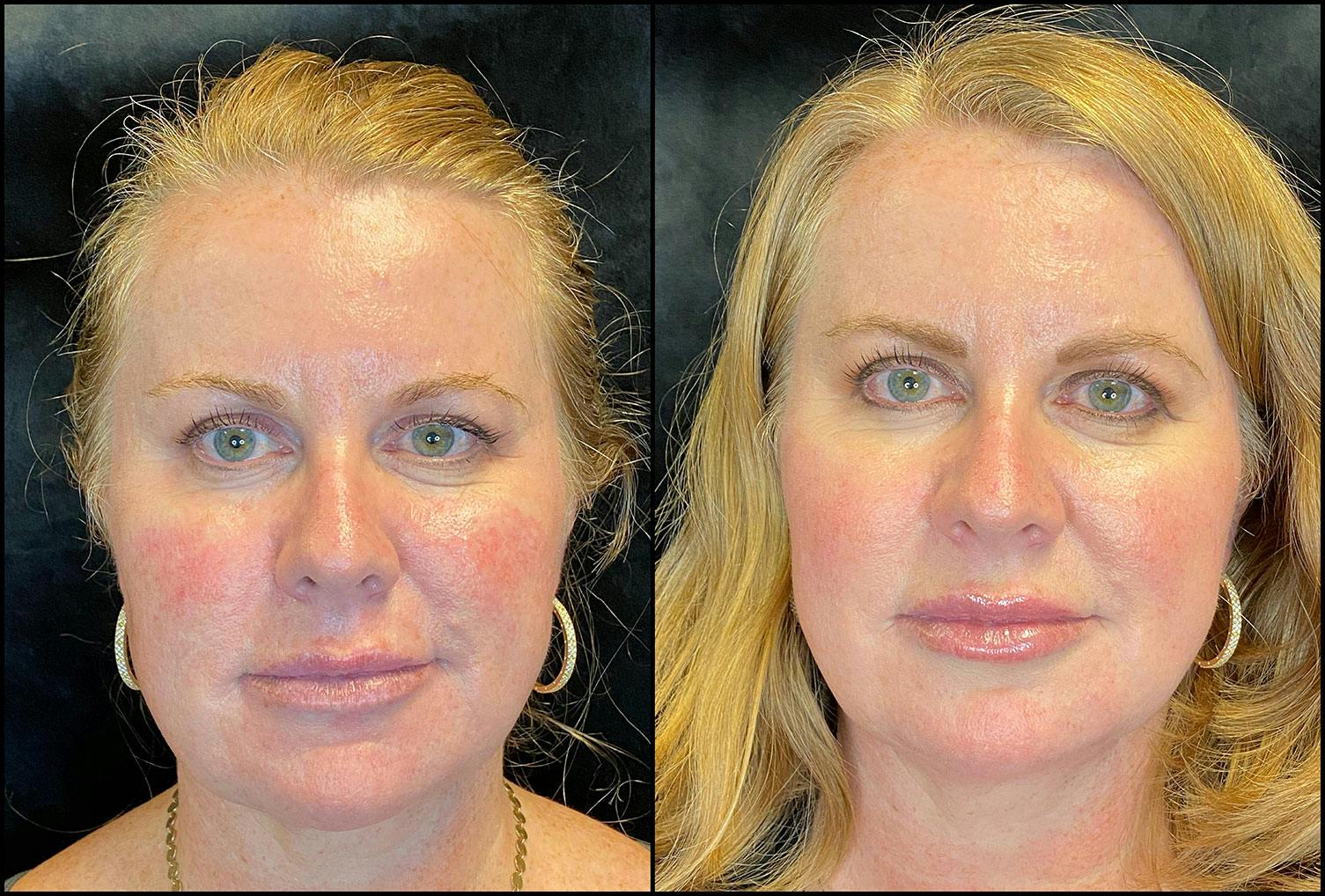 Dermal Fillers Before & After Gallery - Patient 92120664 - Image 2