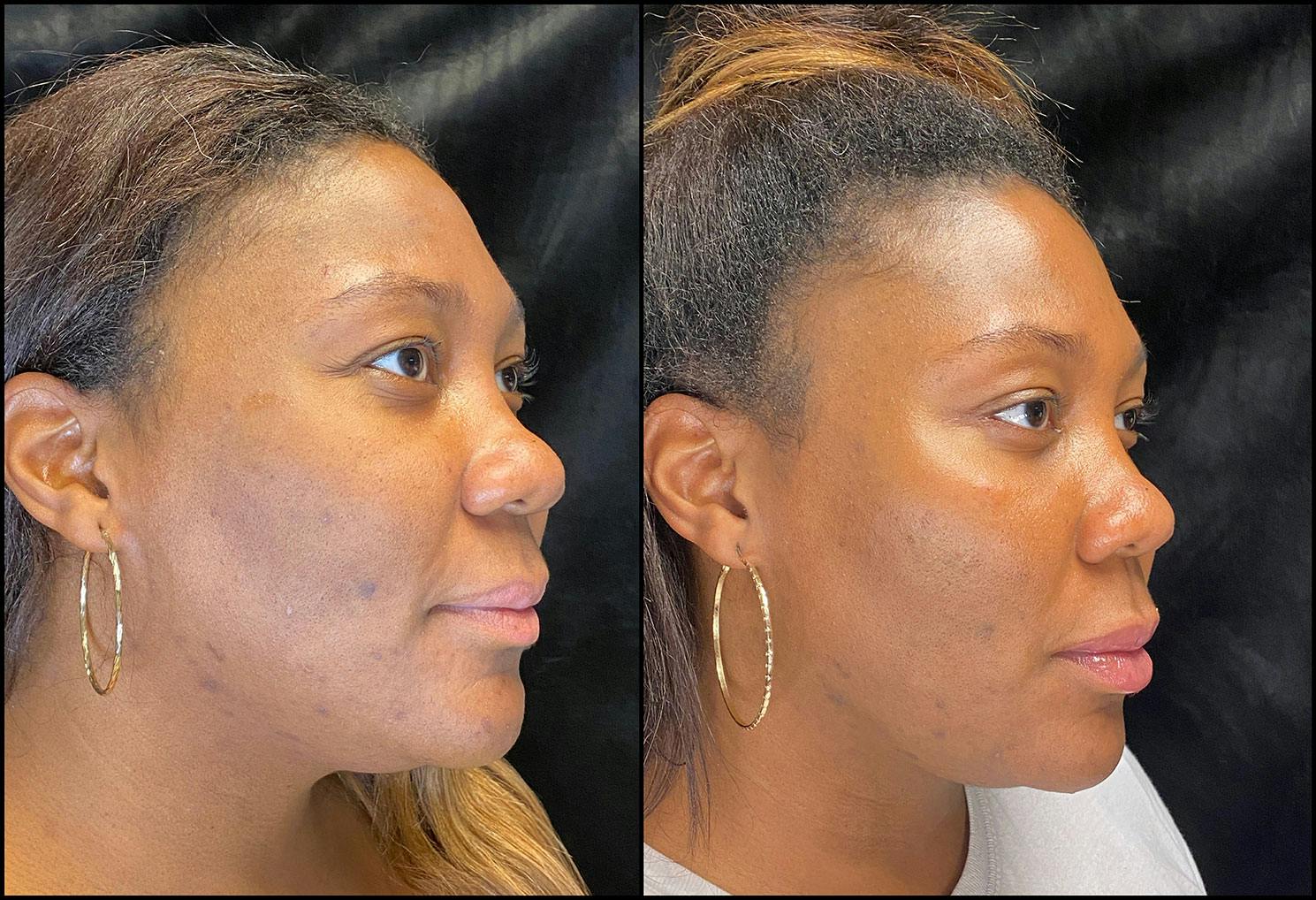 Dermal Fillers Before & After Gallery - Patient 92121805 - Image 5
