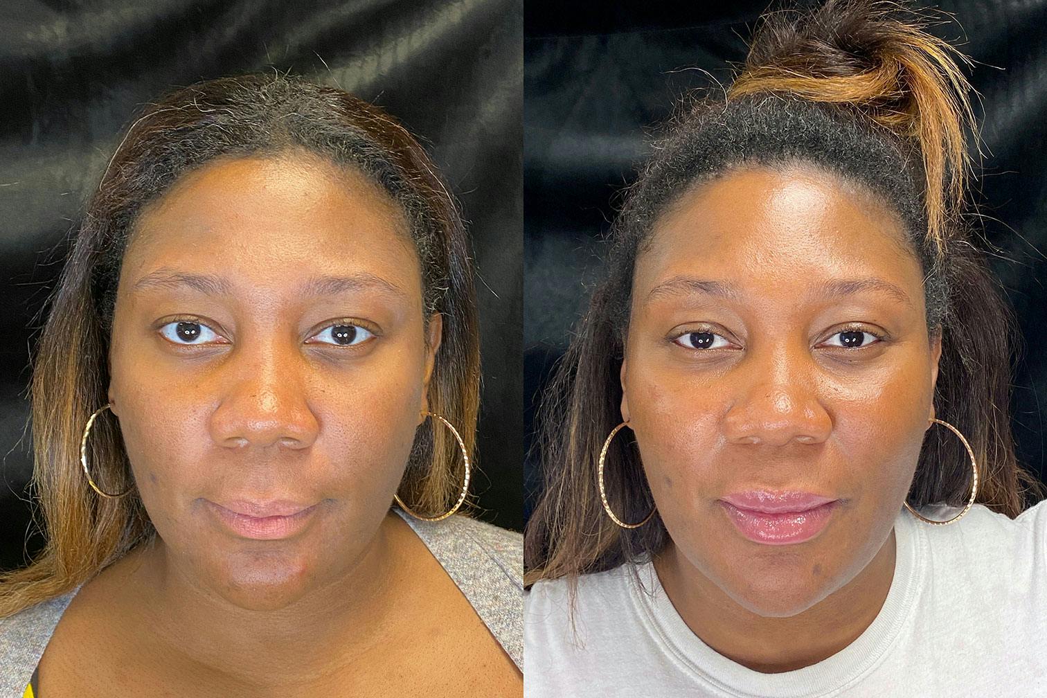 Dermal Fillers Before & After Gallery - Patient 92121805 - Image 1