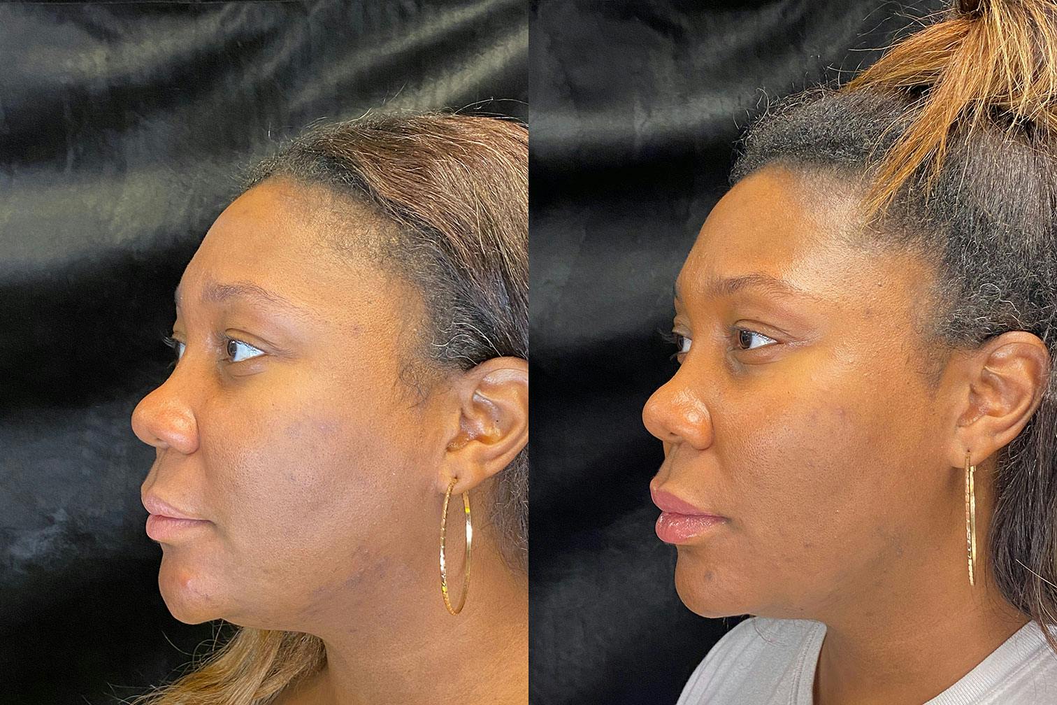 Dermal Fillers Before & After Gallery - Patient 92121805 - Image 3