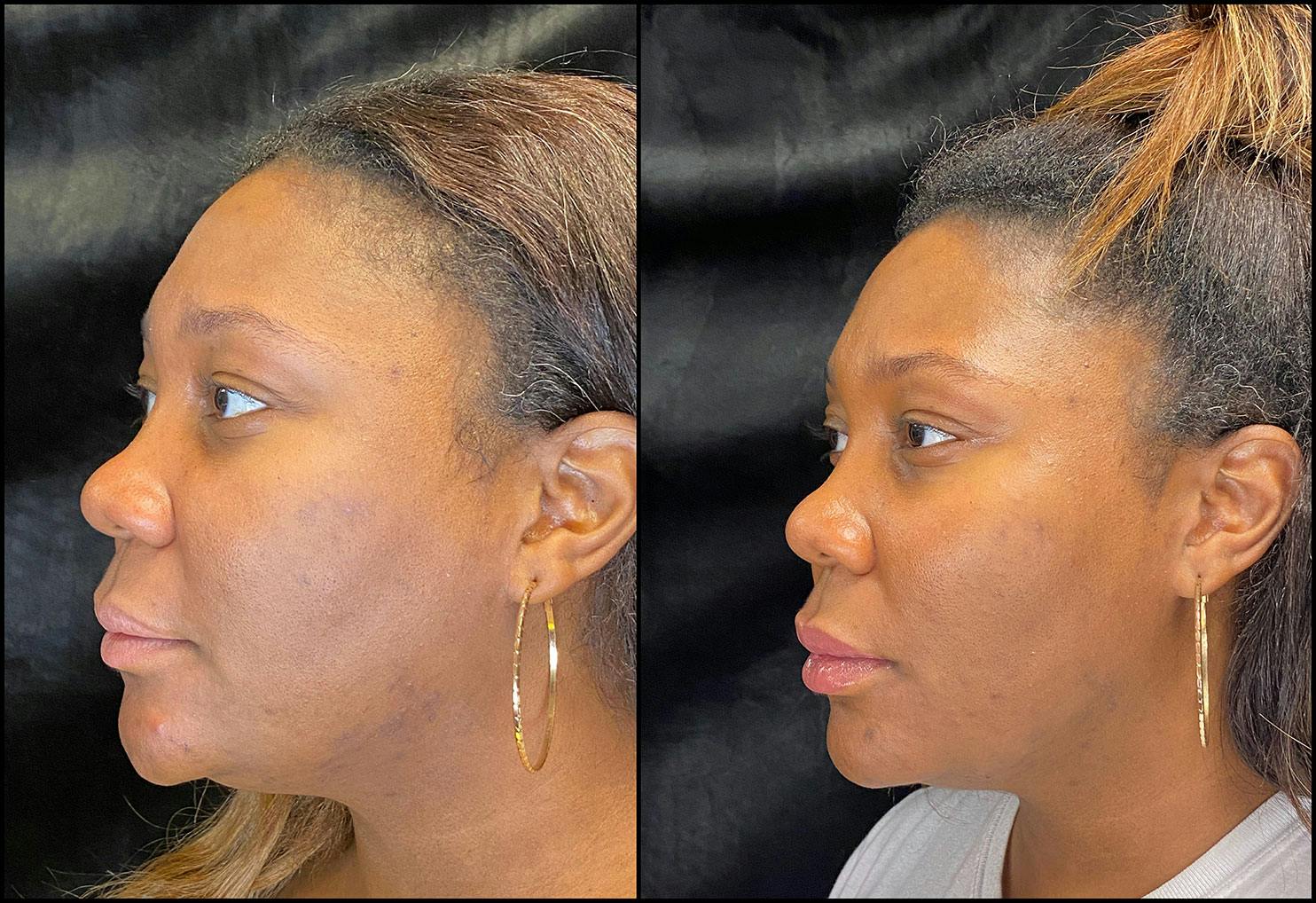 Dermal Fillers Before & After Gallery - Patient 92121805 - Image 4