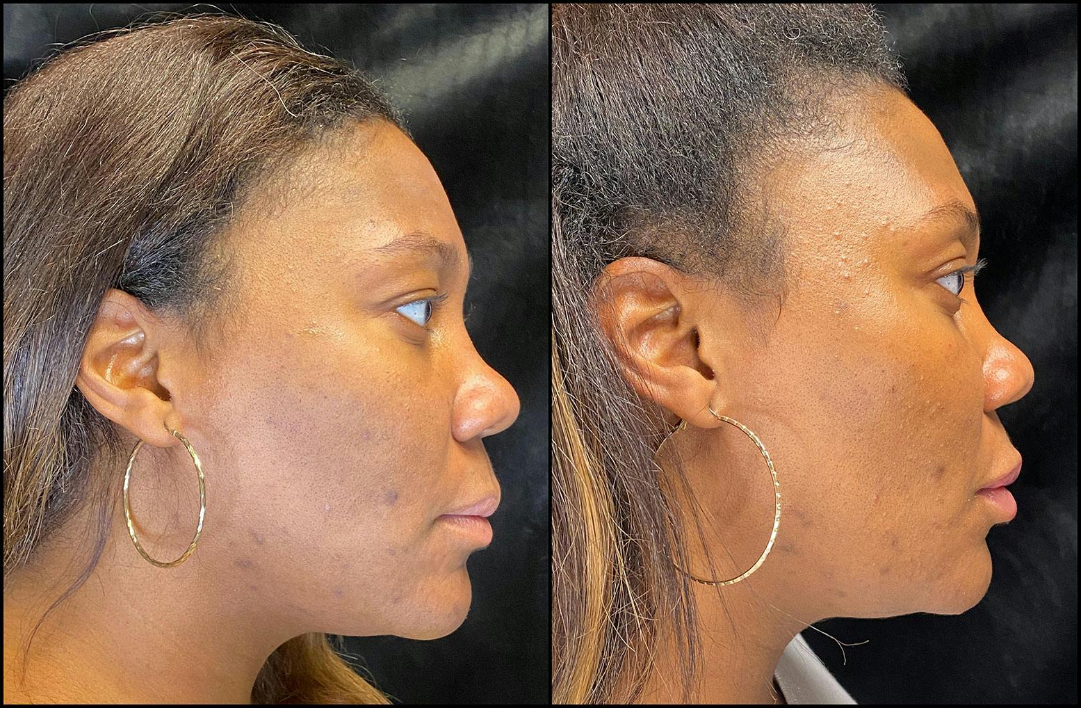 Dermal Fillers Before & After Gallery - Patient 92121805 - Image 6