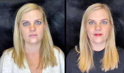 Dermal Fillers Before & After Gallery - Patient 92121842 - Image 1