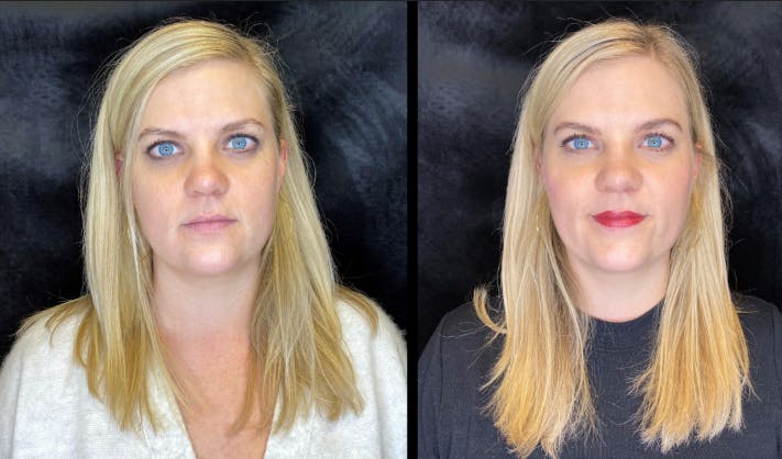 Dermal Fillers Before & After Gallery - Patient 92121842 - Image 1