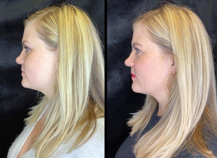 BOTOX/Dysport Before & After Gallery - Patient 92122923 - Image 2