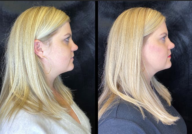 Dermal Fillers Before & After Gallery - Patient 92121842 - Image 3