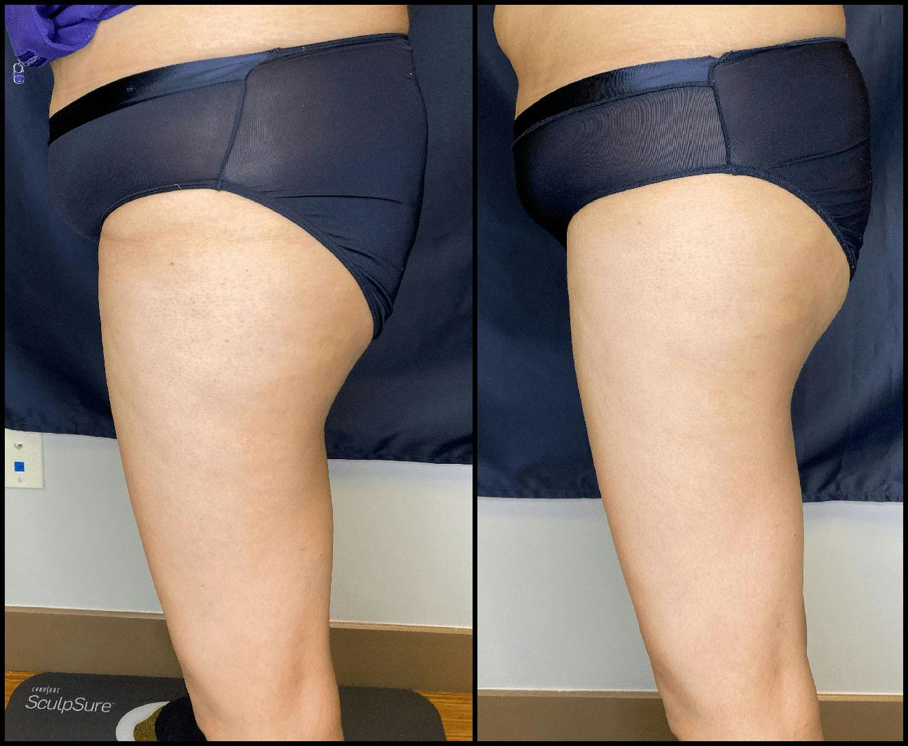 Evolve Before & After Gallery - Patient 92122905 - Image 1