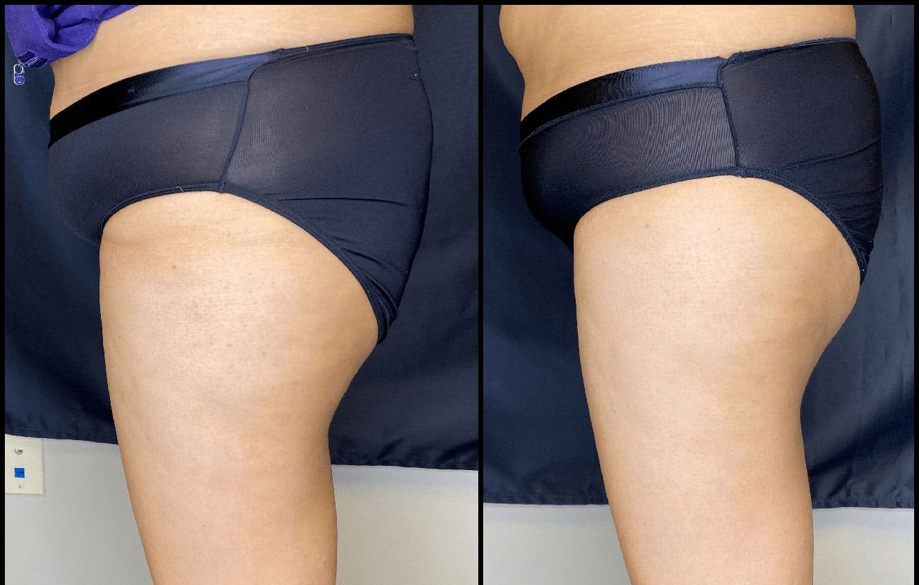 Evolve Before & After Gallery - Patient 92122905 - Image 2