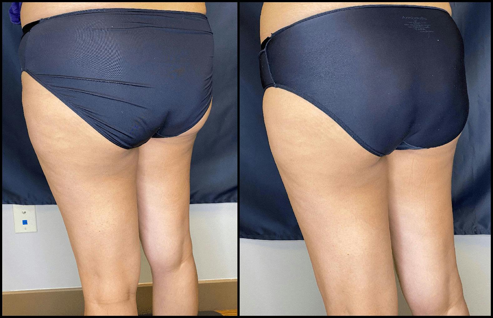 Evolve Before & After Gallery - Patient 92122905 - Image 3
