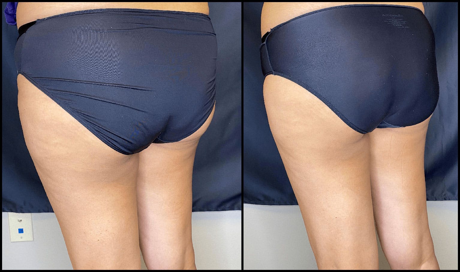 Evolve Before & After Gallery - Patient 92122905 - Image 4