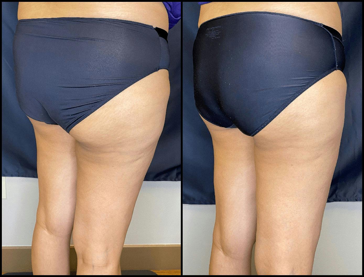 Evolve Before & After Gallery - Patient 92122905 - Image 5
