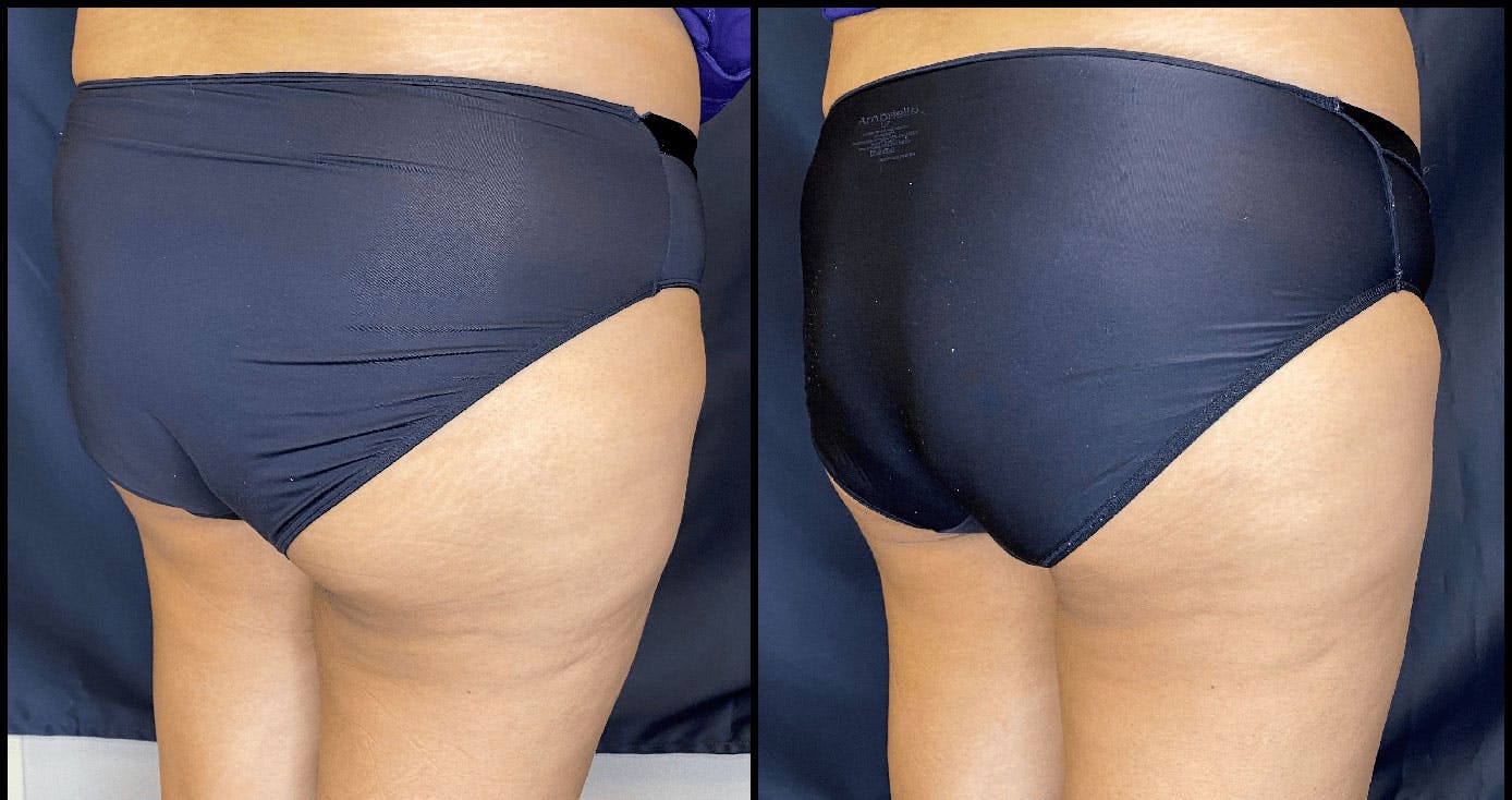 Evolve Before & After Gallery - Patient 92122905 - Image 6