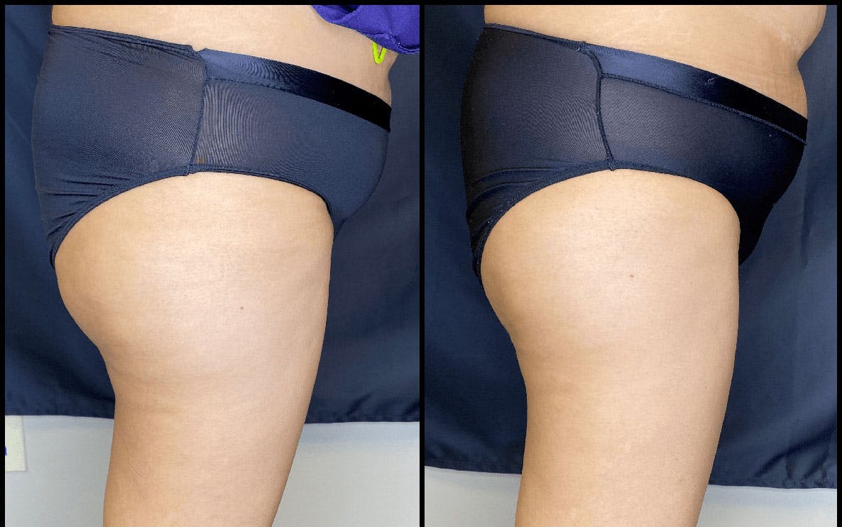 Evolve Before & After Gallery - Patient 92122905 - Image 8