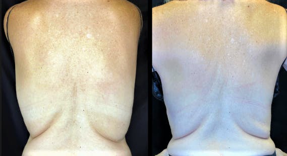 SculpSure Before & After Gallery - Patient 92122924 - Image 1