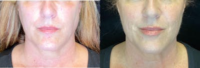 Dermal Fillers Before & After Gallery - Patient 103406785 - Image 1