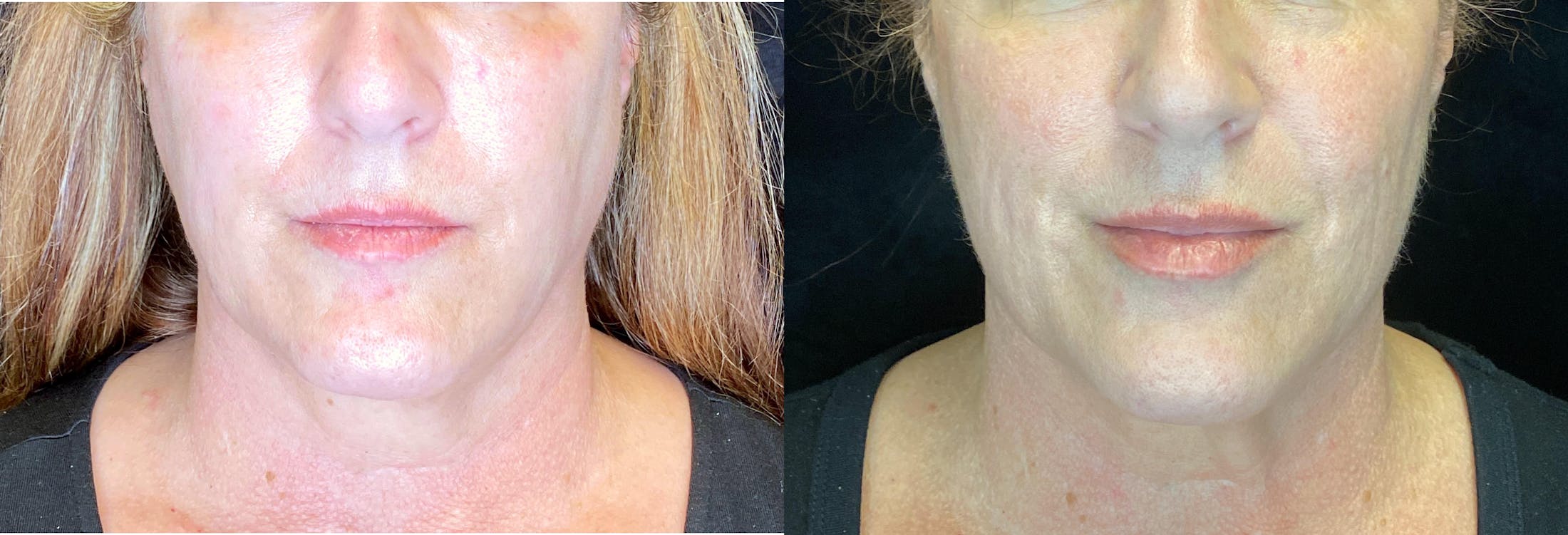 Dermal Fillers Before & After Gallery - Patient 103406785 - Image 1