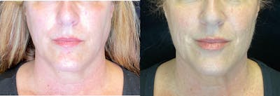 BOTOX/Dysport Before & After Gallery - Patient 103406770 - Image 1