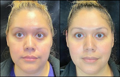 Dermal Fillers Before & After Gallery - Patient 103407220 - Image 1
