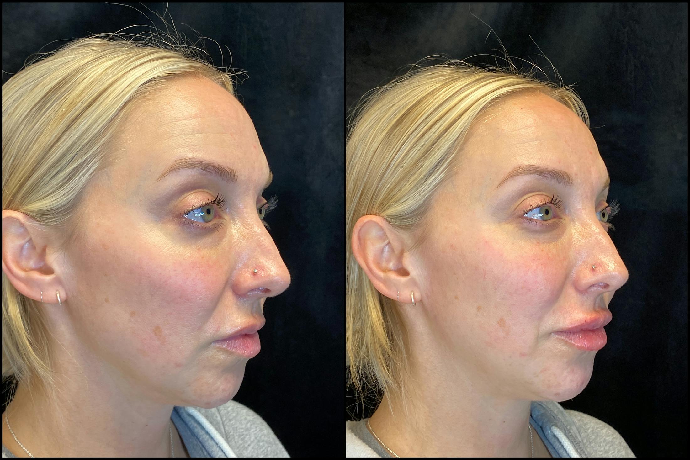 Dermal Fillers Before & After Gallery - Patient 103406850 - Image 1