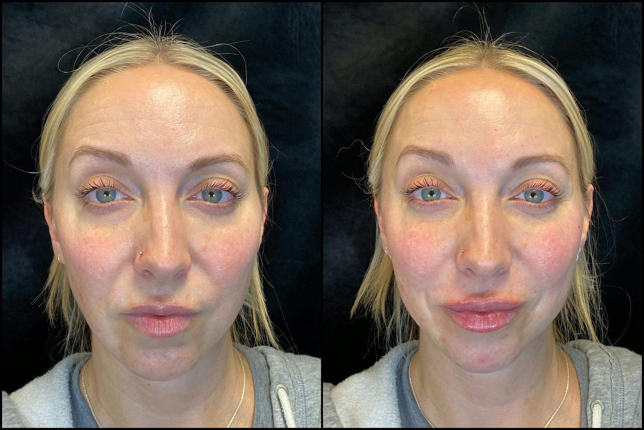 Dermal Fillers Before & After Gallery - Patient 103406850 - Image 2