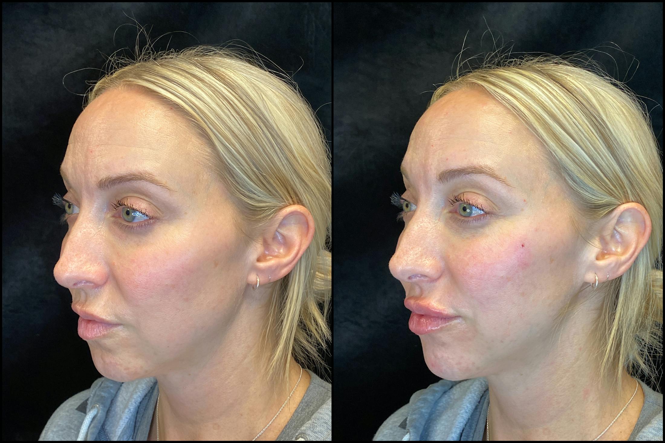 Dermal Fillers Before & After Gallery - Patient 103406850 - Image 3