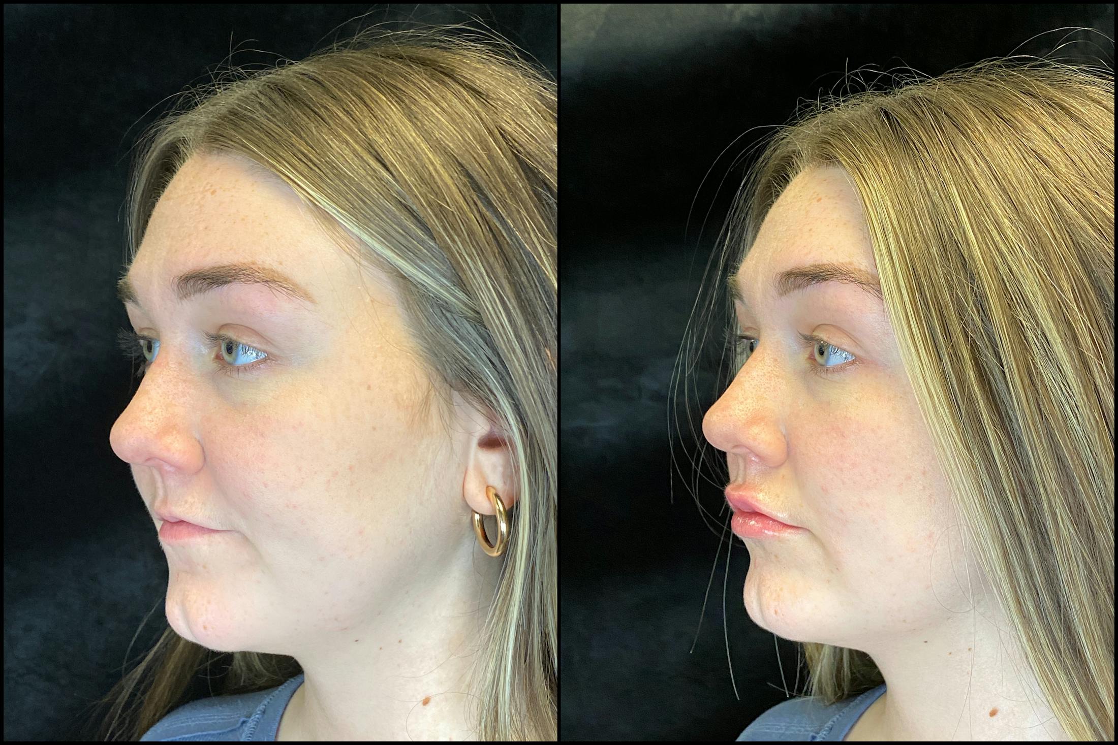 BOTOX/Dysport Before & After Gallery - Patient 120986666 - Image 3